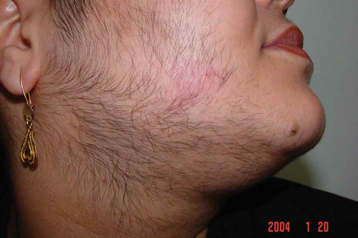 Повышенная волосатость у брюнетки