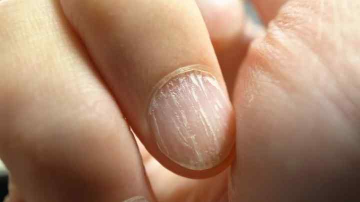 Чому злояться нігті на руках
