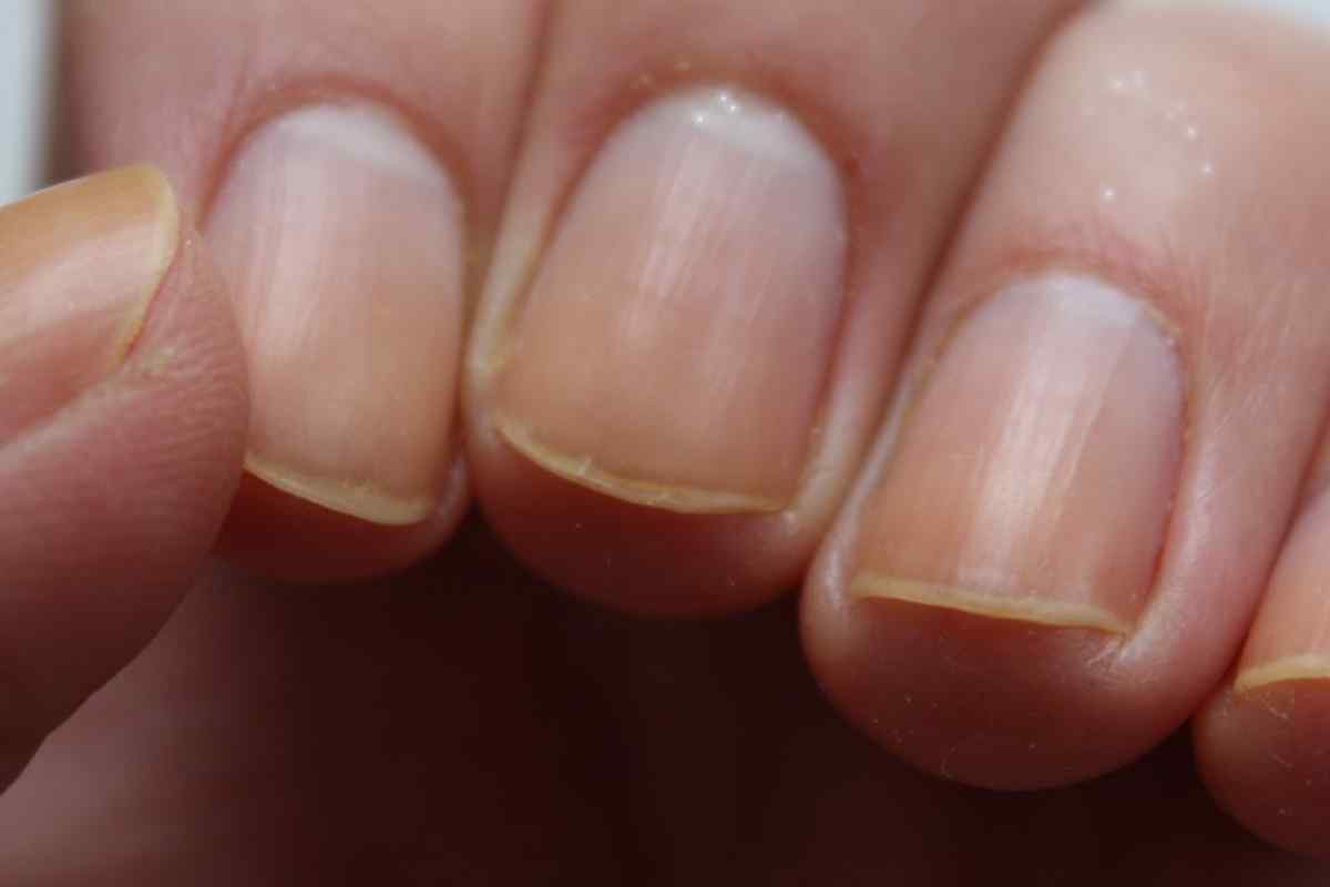 Чому нігті жовтіють