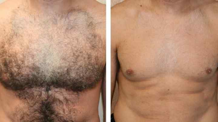 Як позбутися волосся на грудях у чоловіків