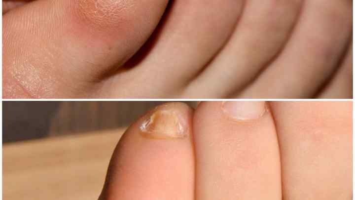 Як видалити мозолі на пальцях ніг