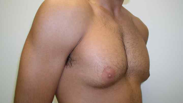 Як прибрати груди у чоловіків