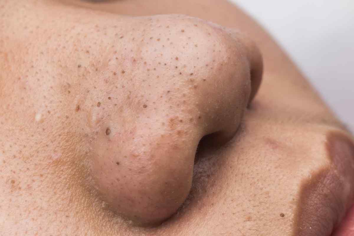 Як позбутися прищів на грудях і спині
