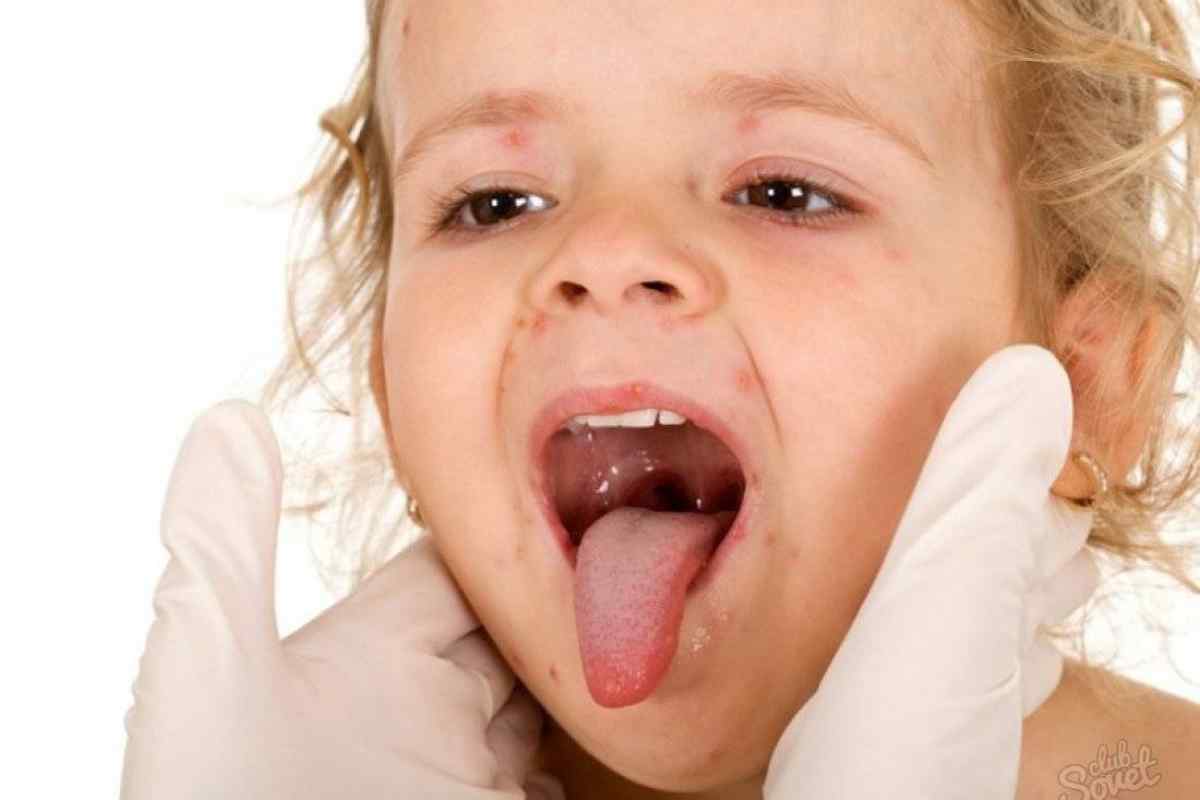 Як лікують горло однорічним діткам