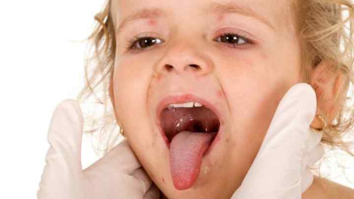 Як лікують горло однорічним діткам