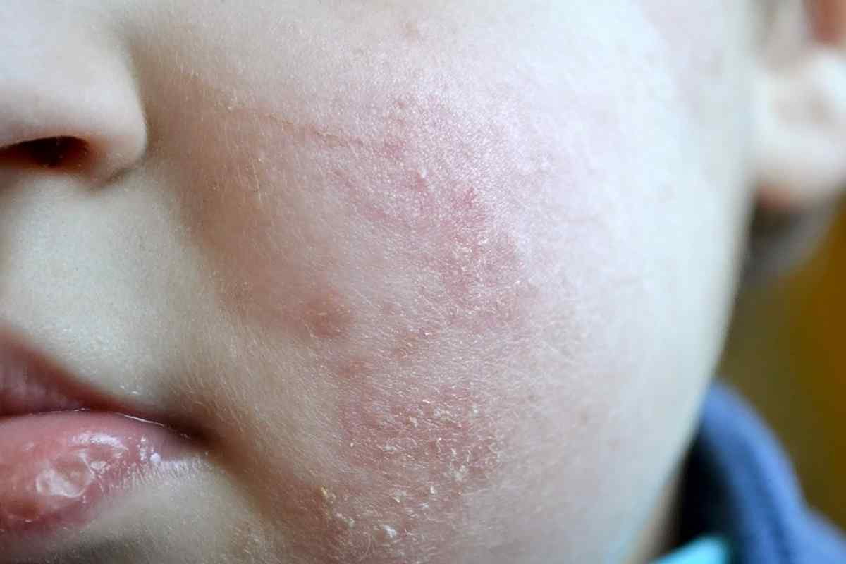 Шкіра дитини: висип, плями, діатез: як розпізнати і лікувати