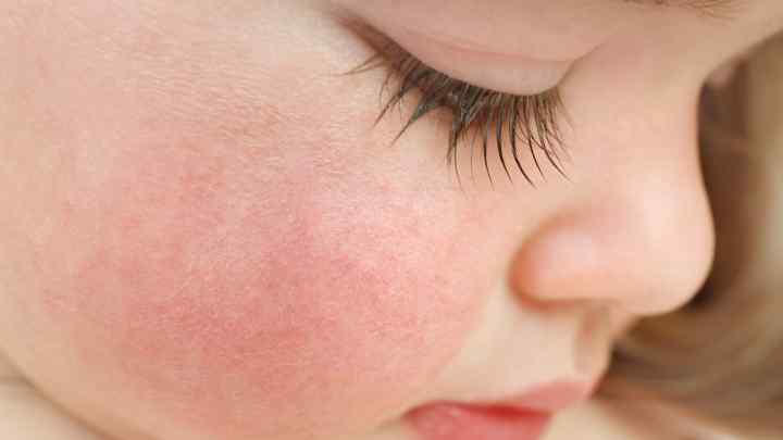 Як визначити алергію у дитини