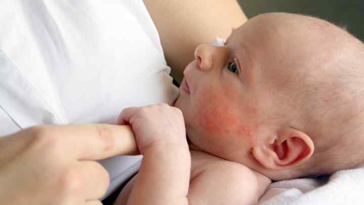 Як лікувати алергію у немовляти