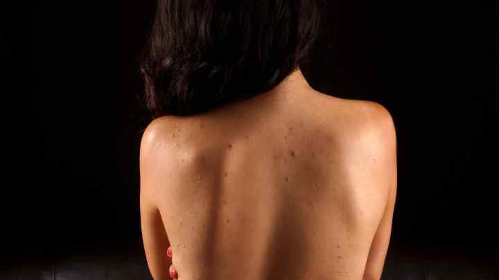 Як позбутися прищів на спині і плечах