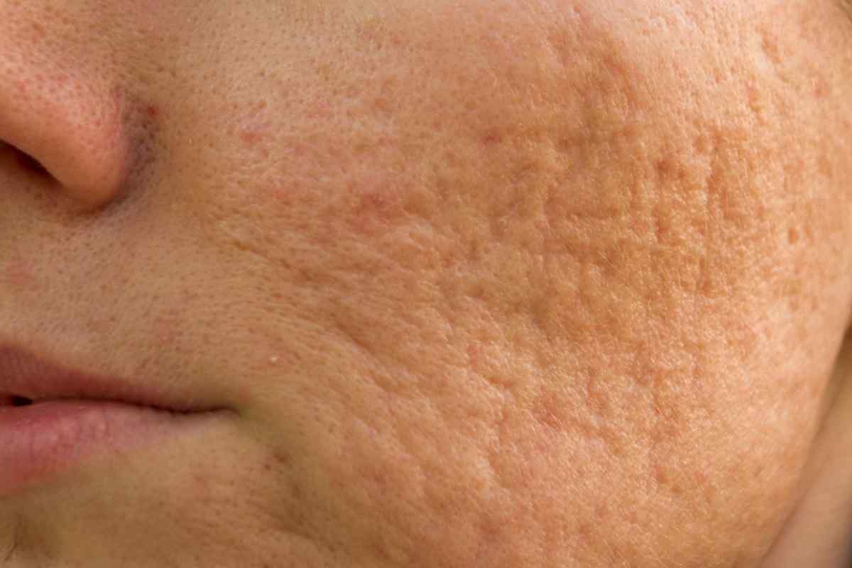 Як вилучити шрами з обличчя