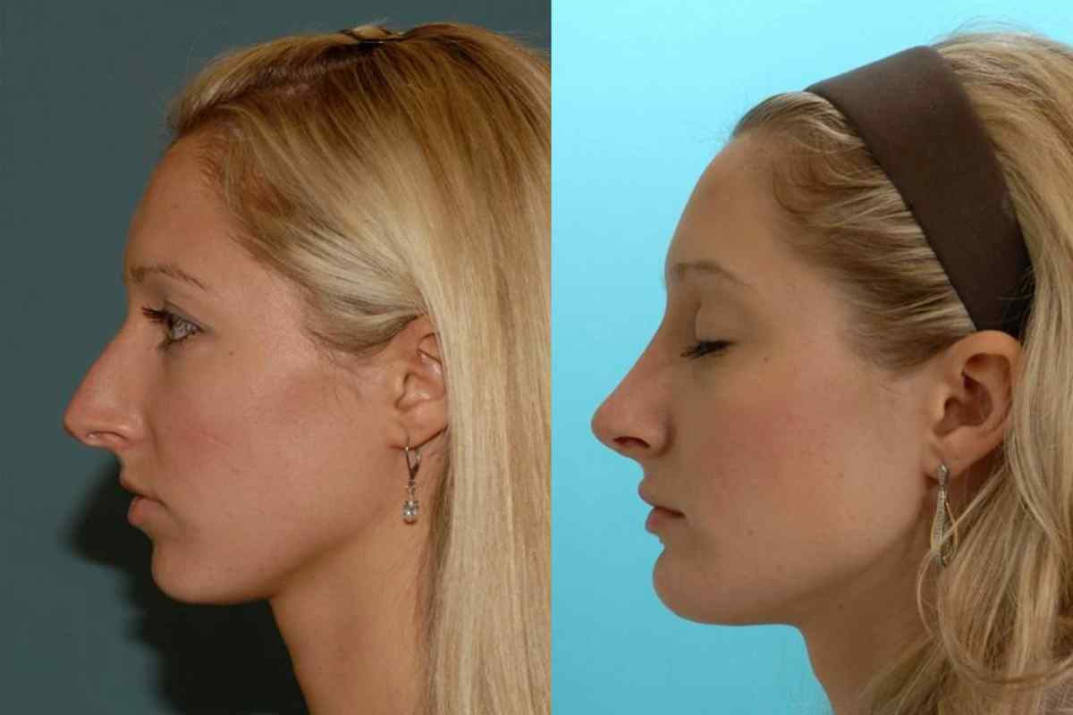 Як виправити форму носа