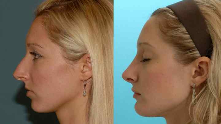Як виправити форму носа