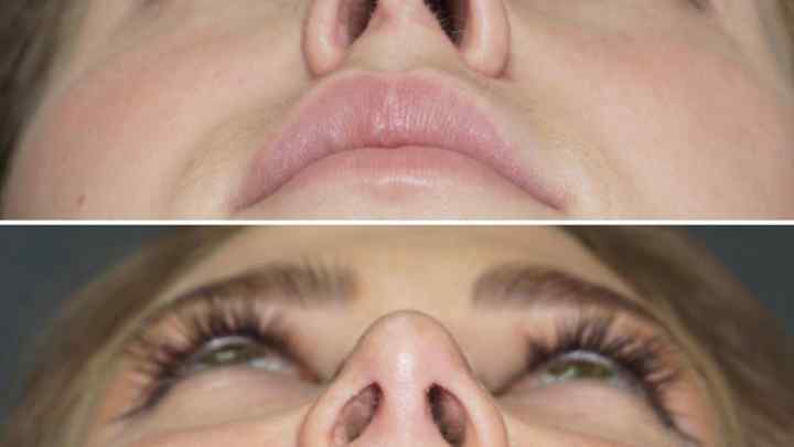 Як виправити перегородку носа