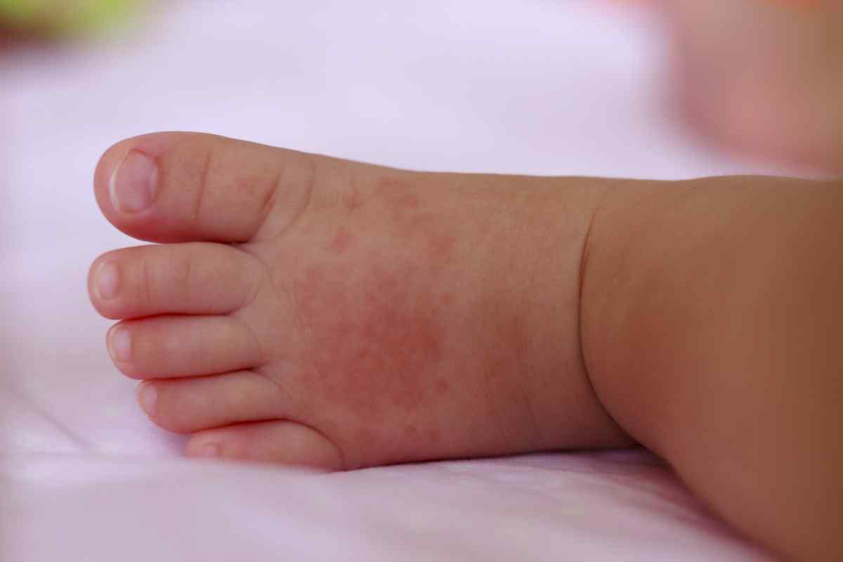 Як вилікувати атопічний дерматит у дитини