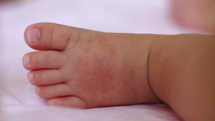 Як вилікувати атопічний дерматит у дитини