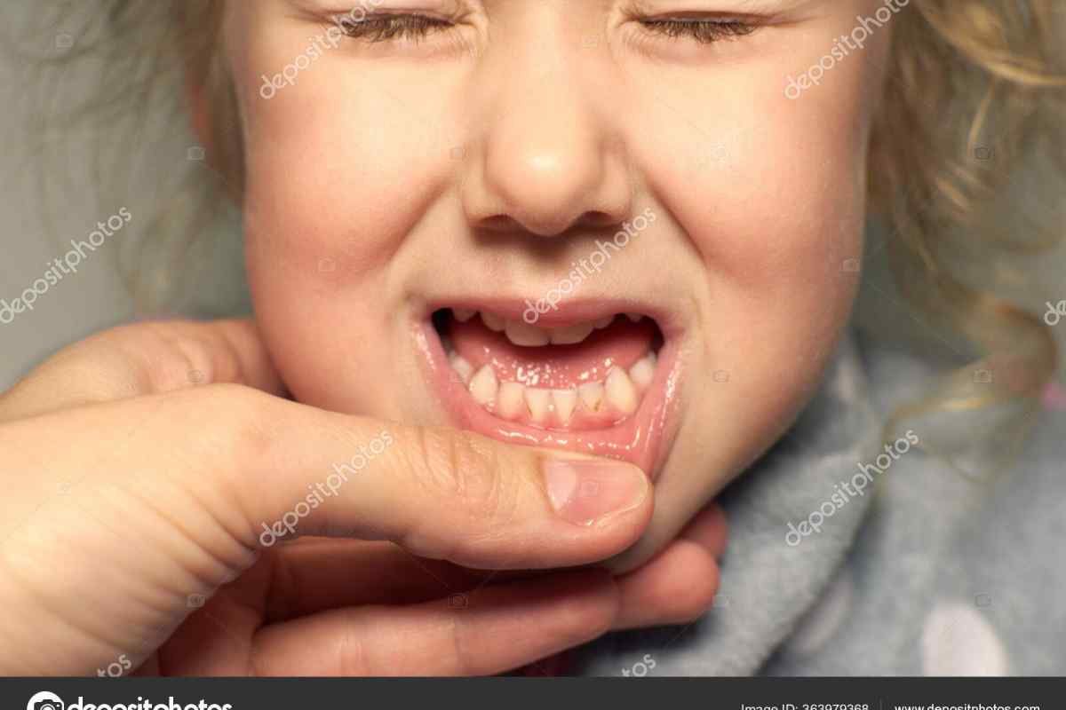 Чому у маленької дитини псуються зуби