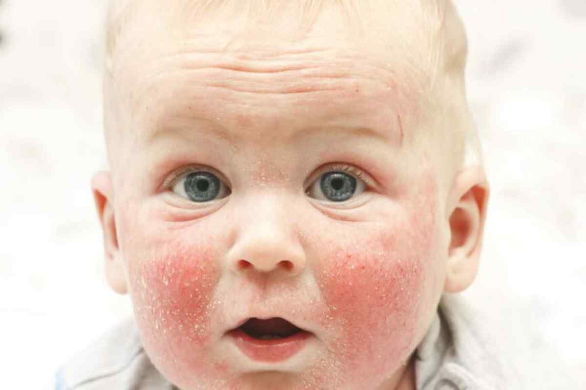 Атопічний дерматит у дітей: причини, симптоми, лікування