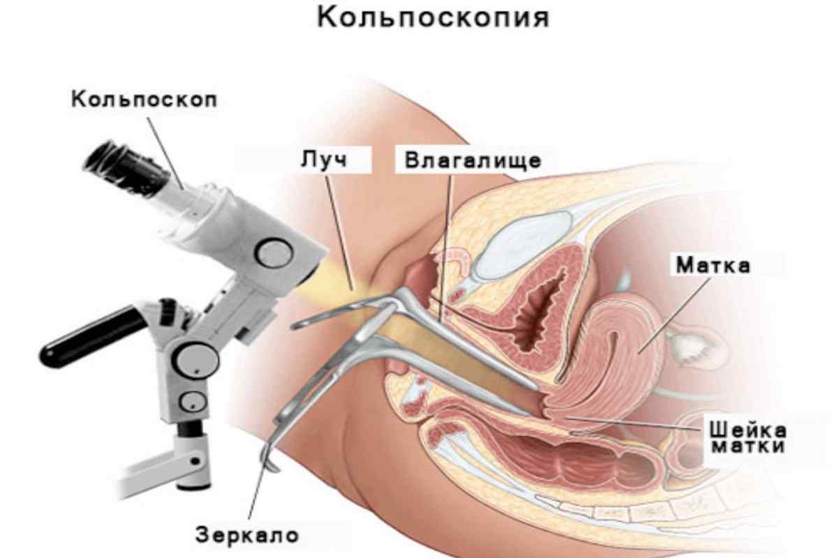 Біопсія шийки матки: особливості проведення операції