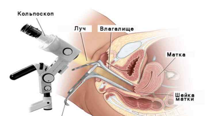 Біопсія шийки матки: особливості проведення операції