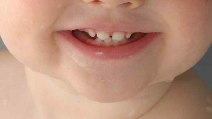 Причина появи білих плям на зубах дитини
