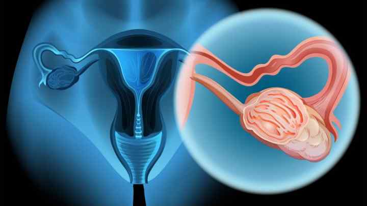 Рак яєчника: симптоми у жінок. Рак яєчників: ознаки, діагностика, прогноз