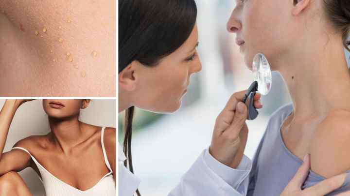 Новоутворення на шкірі: причини, види, лікування. Злоякісні й доброякісні новоутворення