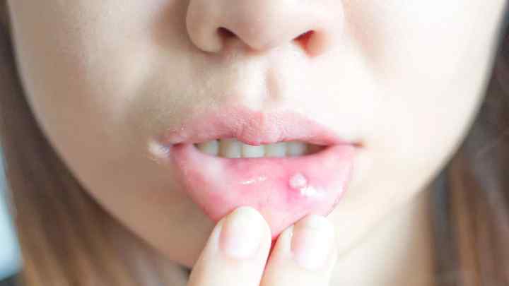Герпес у роті: симптоми, лікування. Герпес у роті у дитини