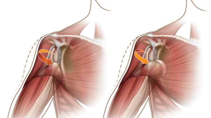 Пошкодження Хілл-Сакса плечового суглоба: причини, симптоми, діагностика та лікування