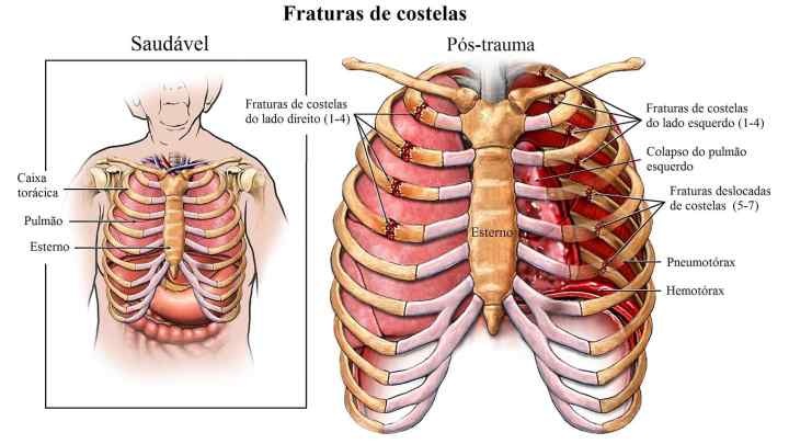 Синдром верхньої апертури грудної клітини: опис, причини та особливості лікування