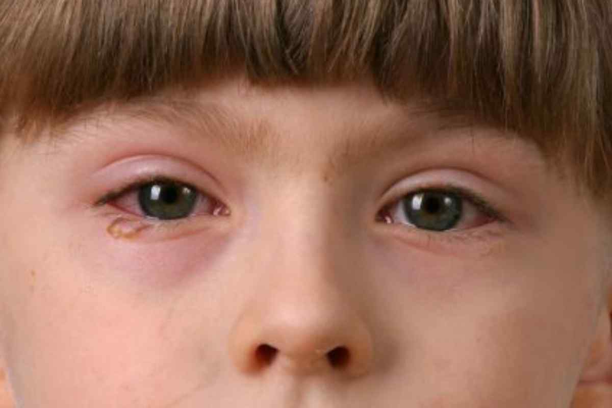 Запалення нижнього століття ока: види, причини та лікування
