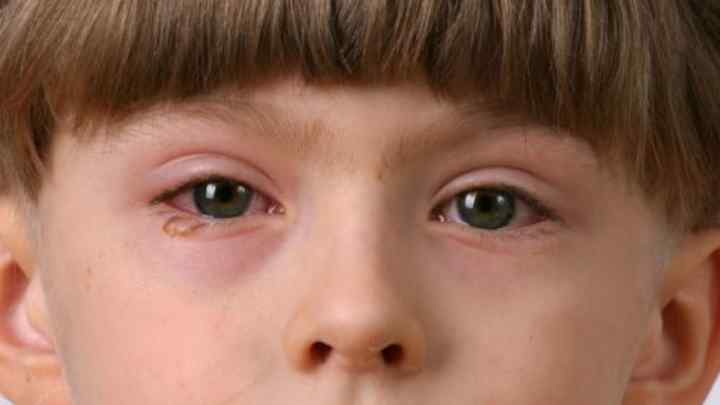 Запалення нижнього століття ока: види, причини та лікування