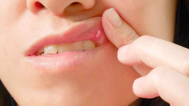 Молочниця в роті у дорослих: симптоми, причини та лікування