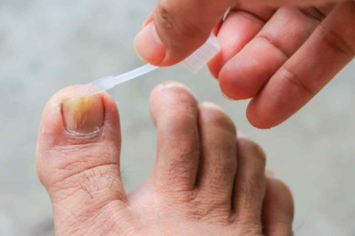 Коричнева пляма на нігті великого пальця ноги: причини, можливі захворювання, методи лікування, профілактика