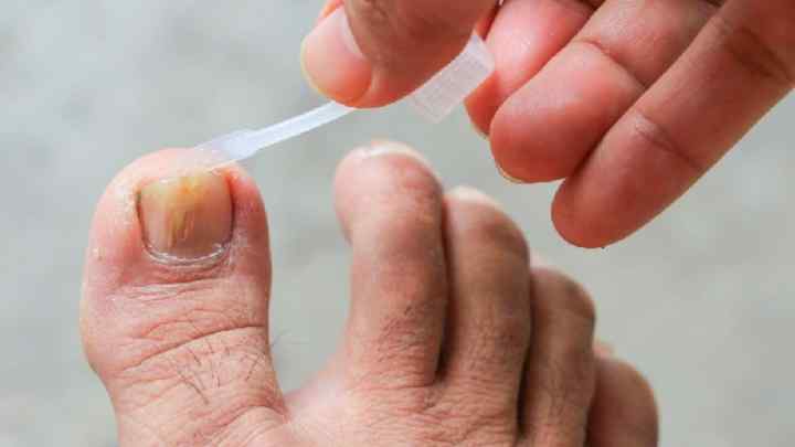 Коричнева пляма на нігті великого пальця ноги: причини, можливі захворювання, методи лікування, профілактика