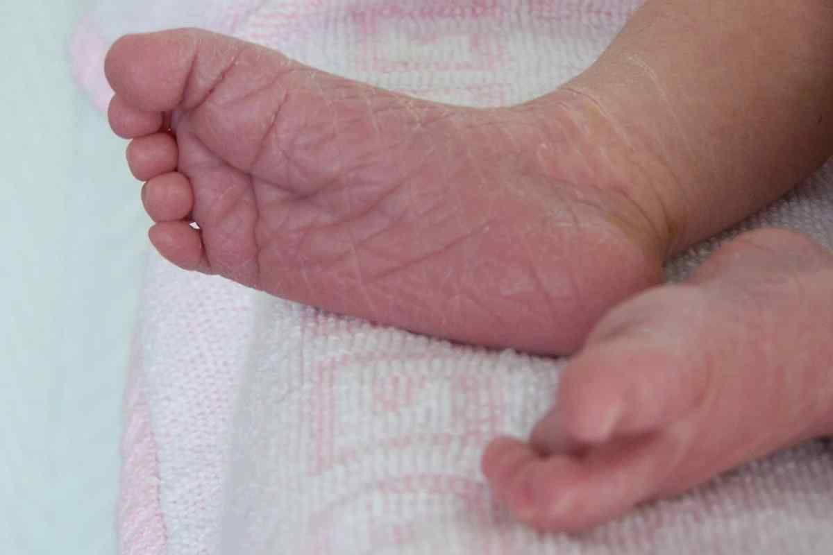 Тріскається шкіра на пальцях ніг у дитини: можливі причини та способи лікування