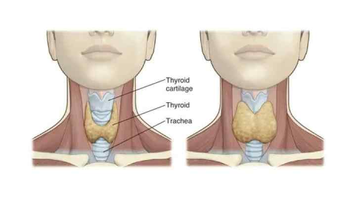 Маленька щитовидна залоза: причини, лікування та наслідки