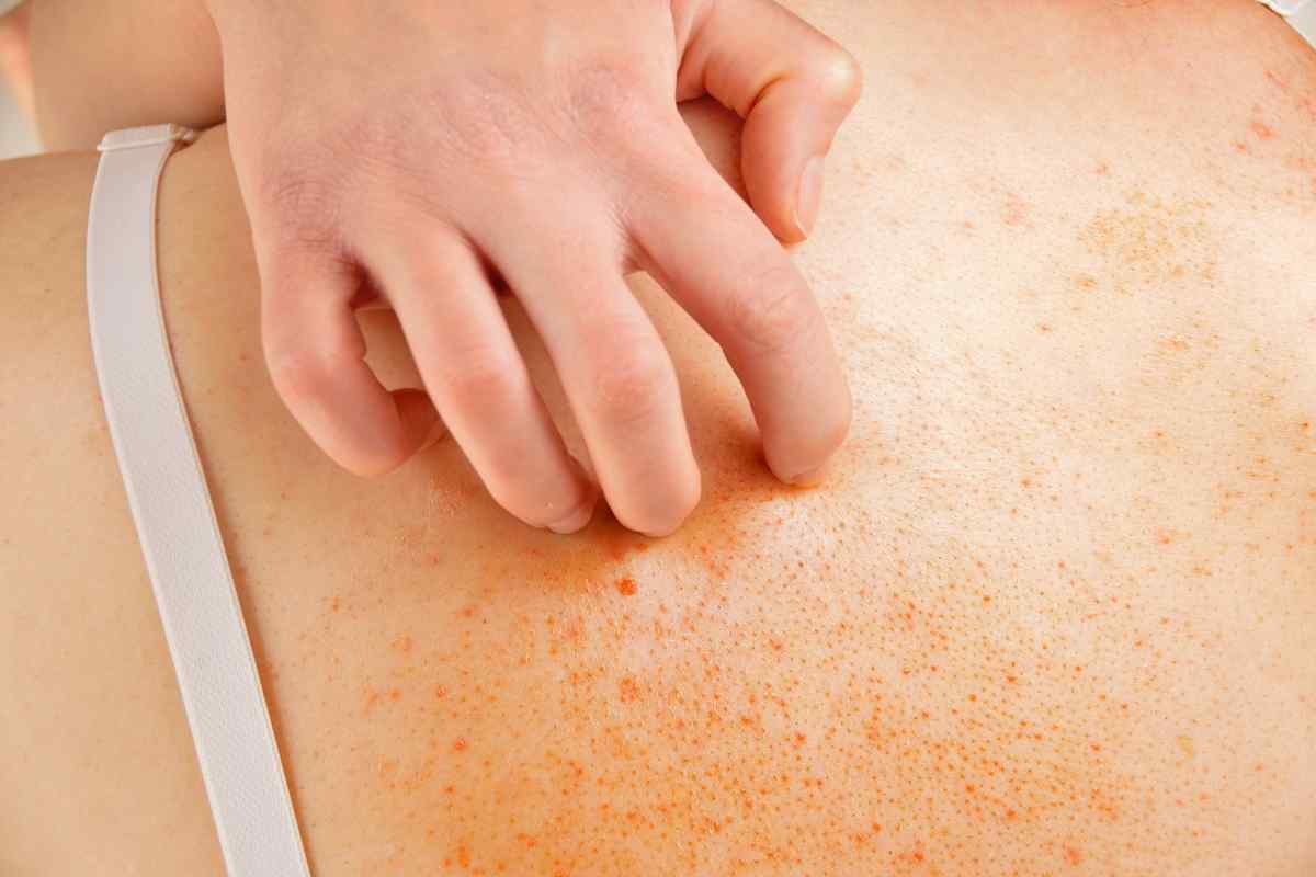 Абсцес шкіри - причини, симптоми, діагностика та лікування