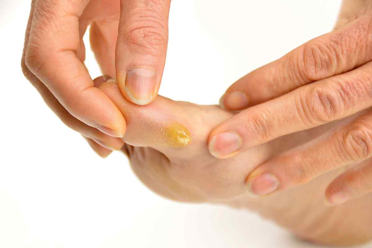 Бородавки на пальцях ніг: лікування лікарськими препаратами. Як вивести бородавку