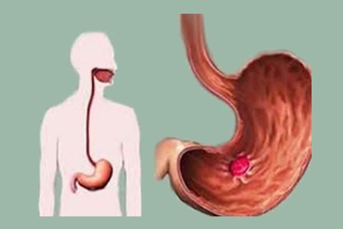 Еозинофільний гастрит у людини: причини хвороби, симптоми та методи лікування