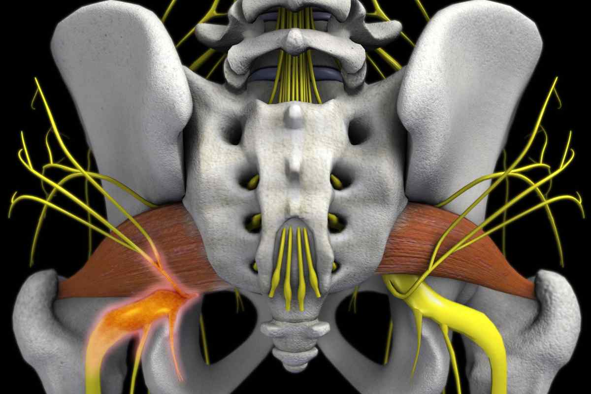 Невропатія стегнового нерва - причини, симптоми та особливості лікування