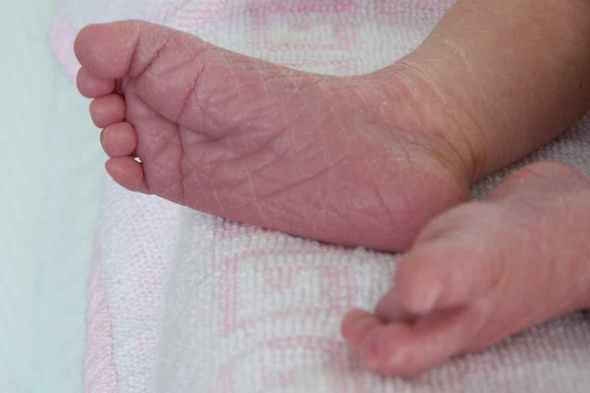 Облазить шкіра на ступнях у дитини - можливі причини та особливості лікування