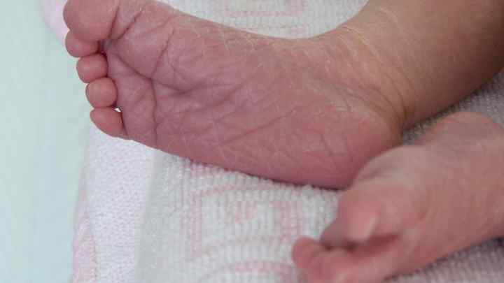 Облазить шкіра на ступнях у дитини - можливі причини та особливості лікування