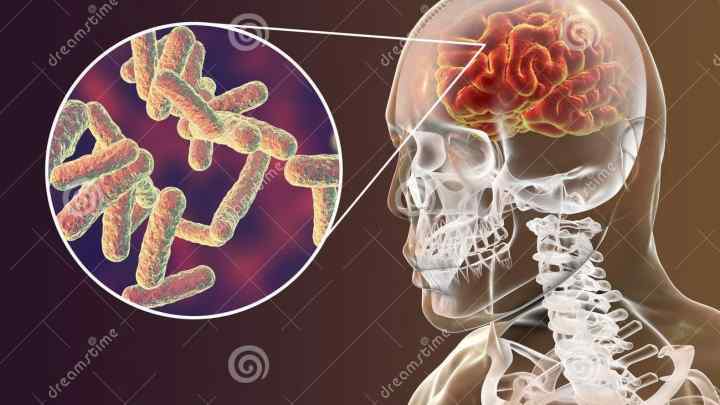 Туберкульоз головного мозку: перші ознаки і симптоми