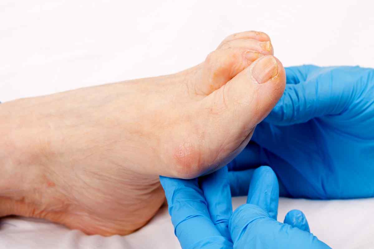 Набряк ніг при діабеті: можливі причини та особливості лікування