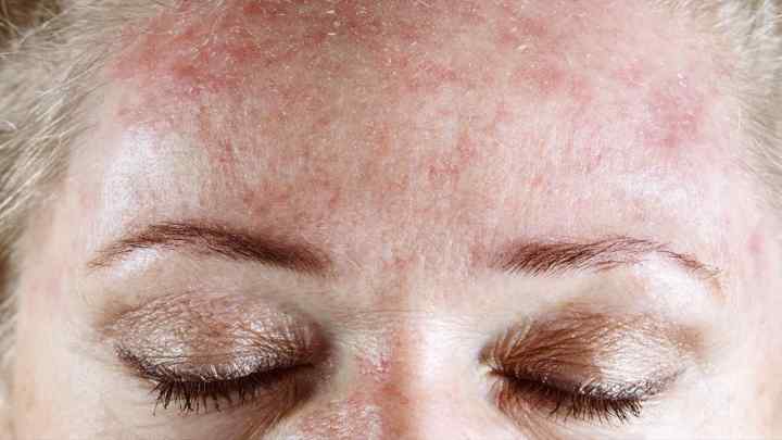 Дерматит шкіри голови: причини, симптоми та лікування народними засобами і препаратами