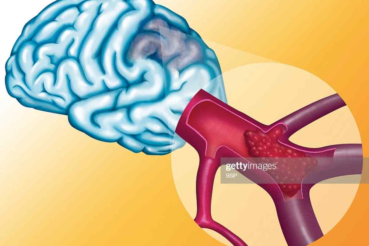 Як лікують судини головного мозку: препарати, народні засоби