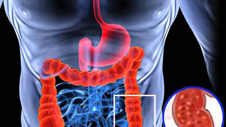 Синдром дірявого кишечника: симптоми і лікування