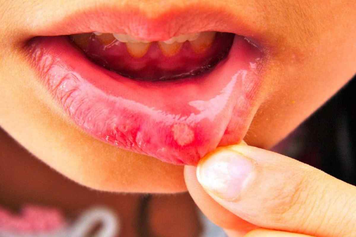 Болячка в роті: причини та лікування