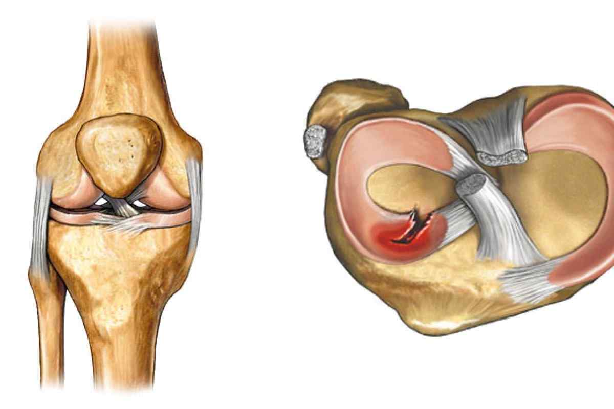 Операція на колінному суглобі на меніску, відновлення