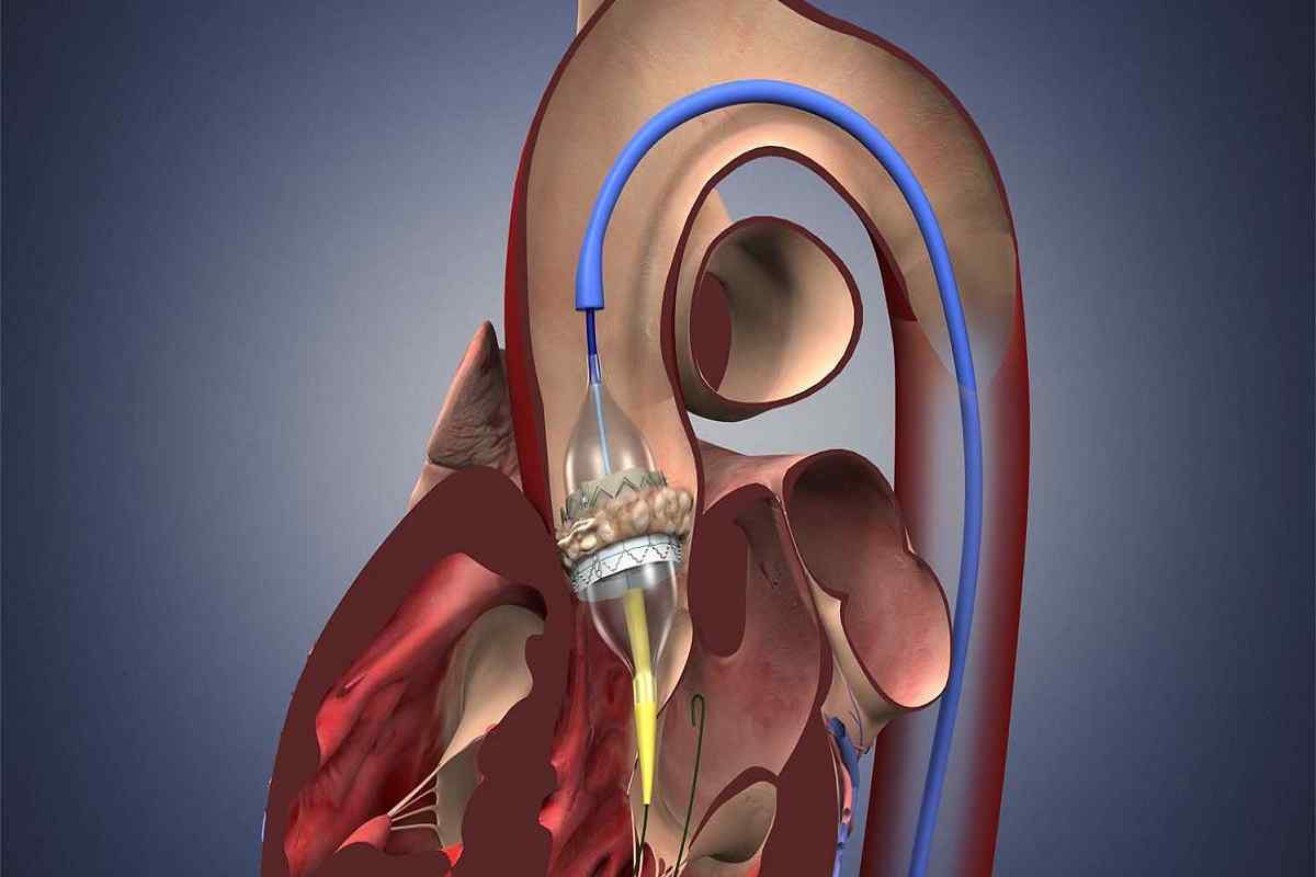 Клапан серця - значення в організмі, види, протезування